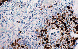Cervical Cancer: Ki-67 — Anti-Mouse HRP (1)